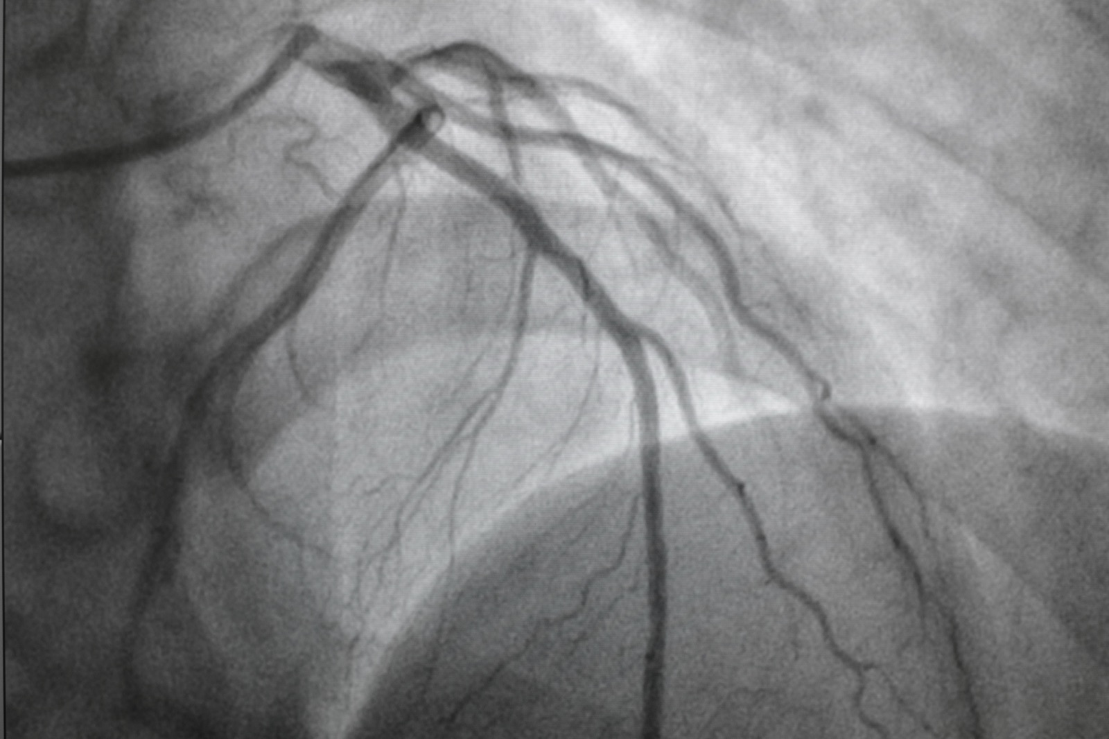 Coronary angiogram image