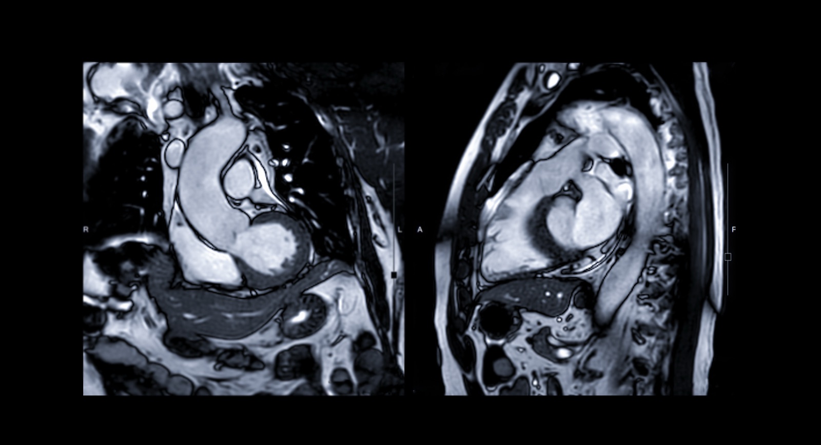 Cardiac MRI scanner