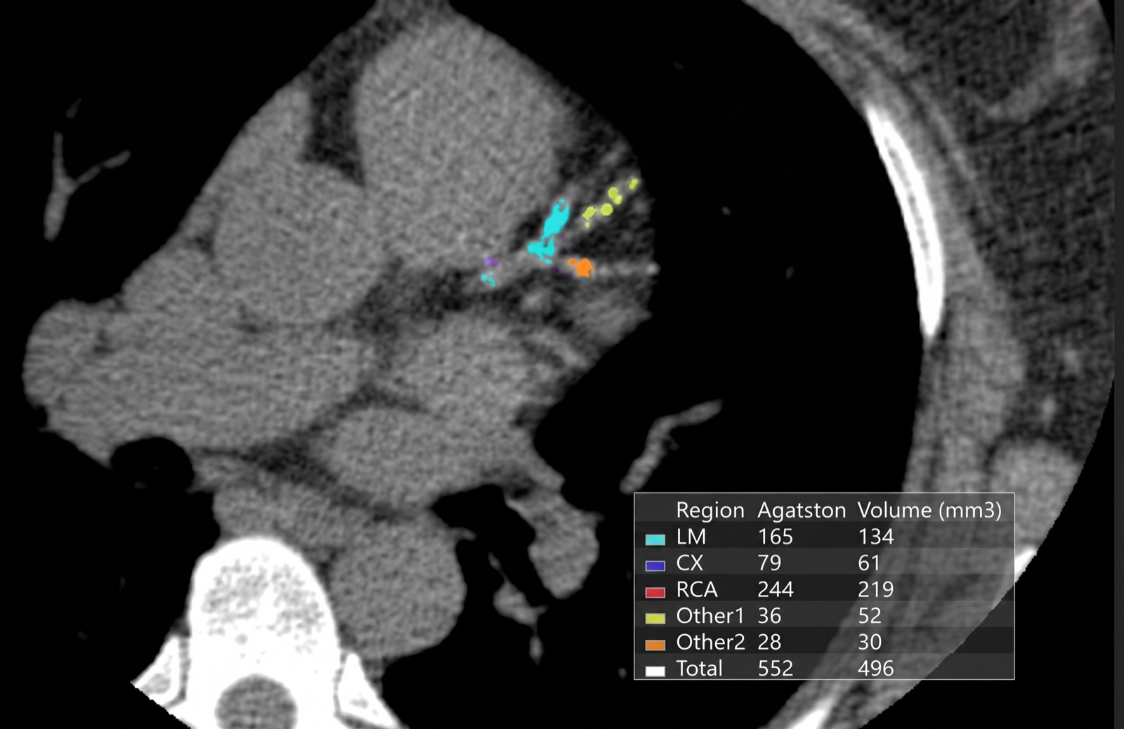 CT calcium score scan