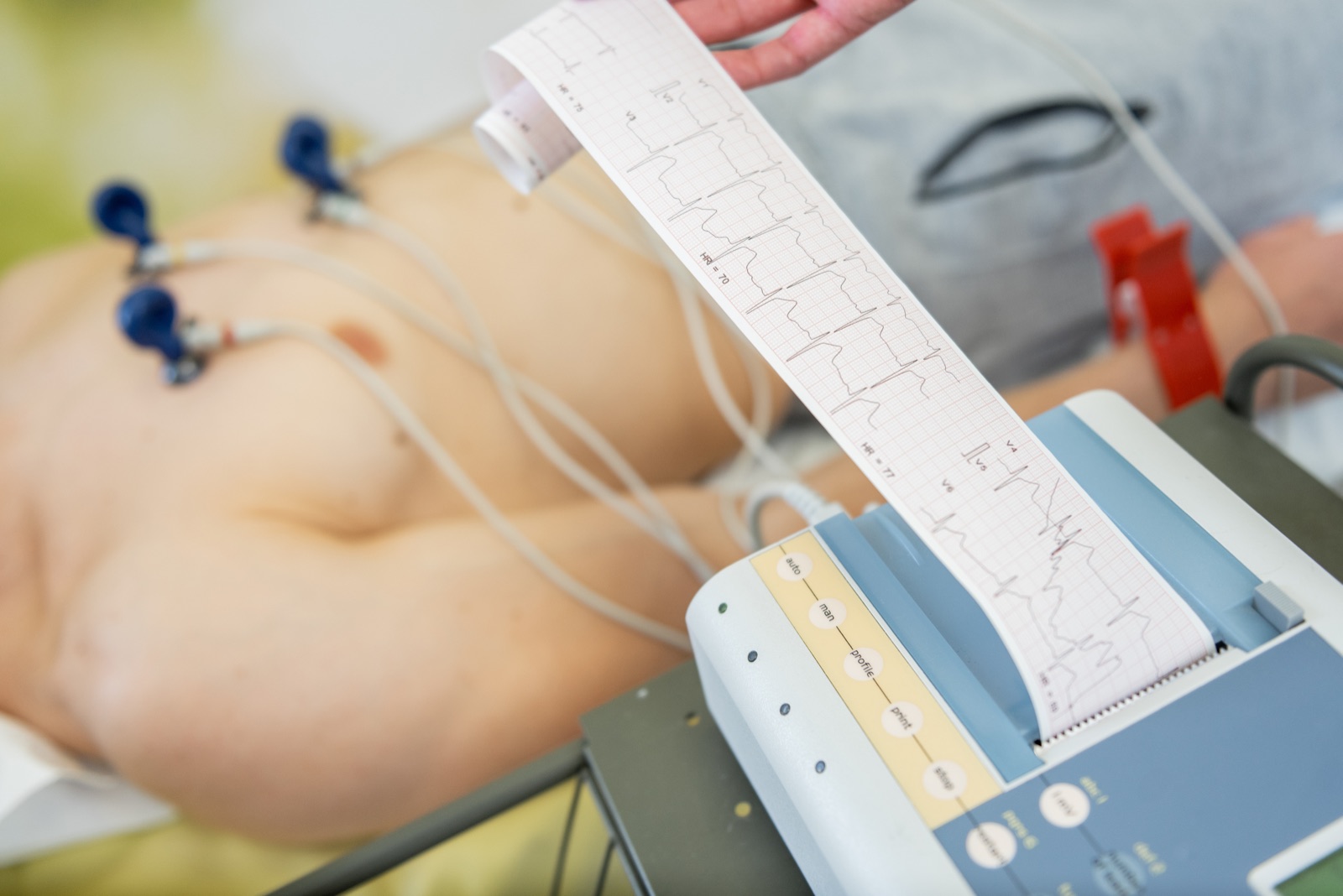 Electrocardiogram trace