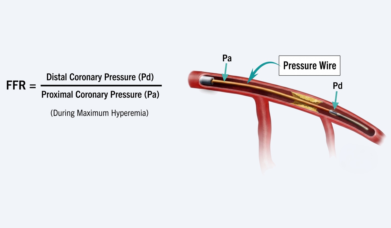 Fractional flow reserve measurement