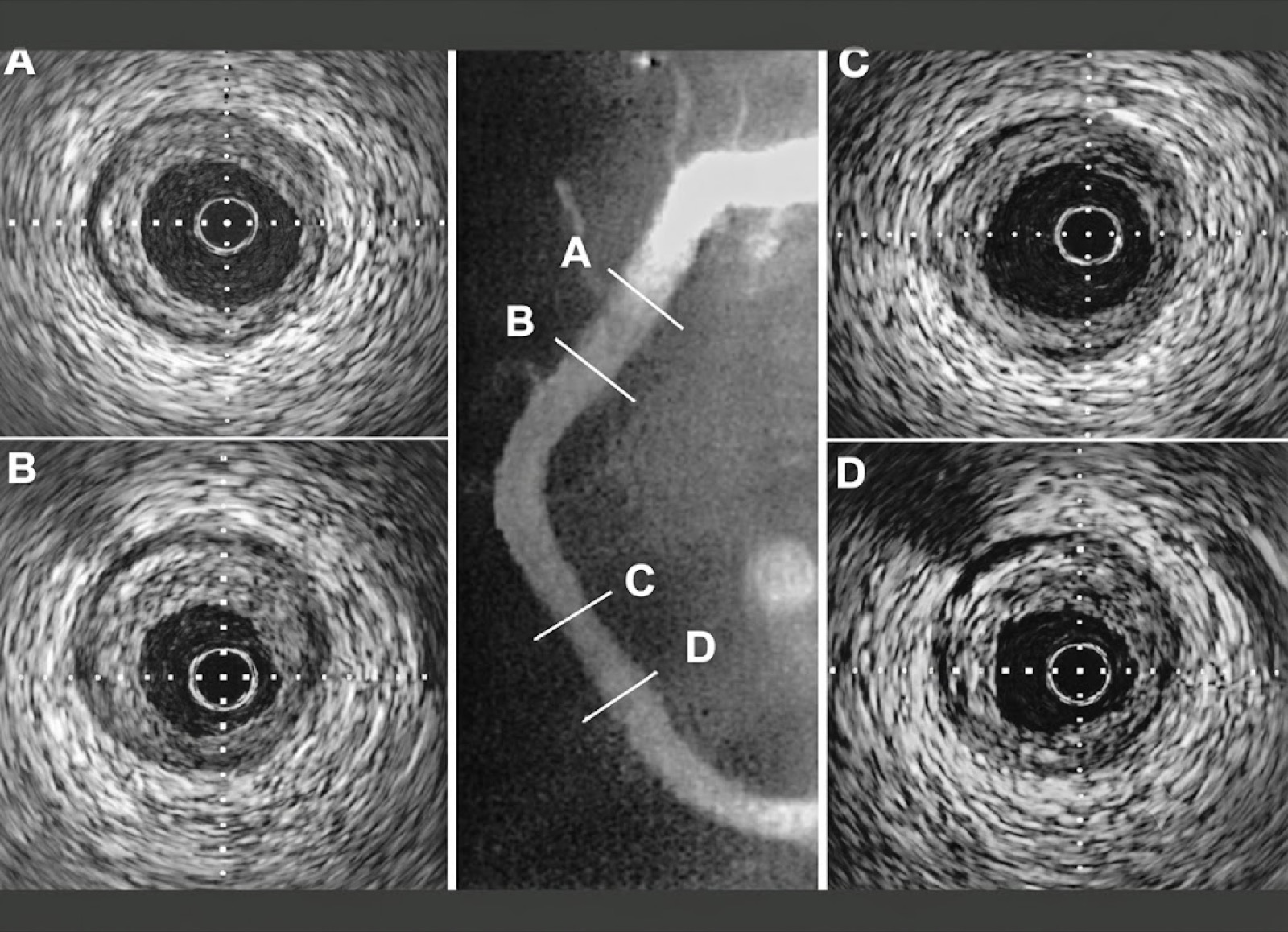 Intravascular ultrasound image