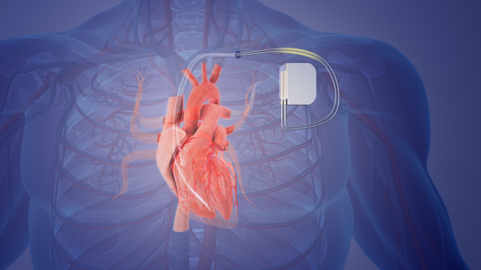 Pacemaker device