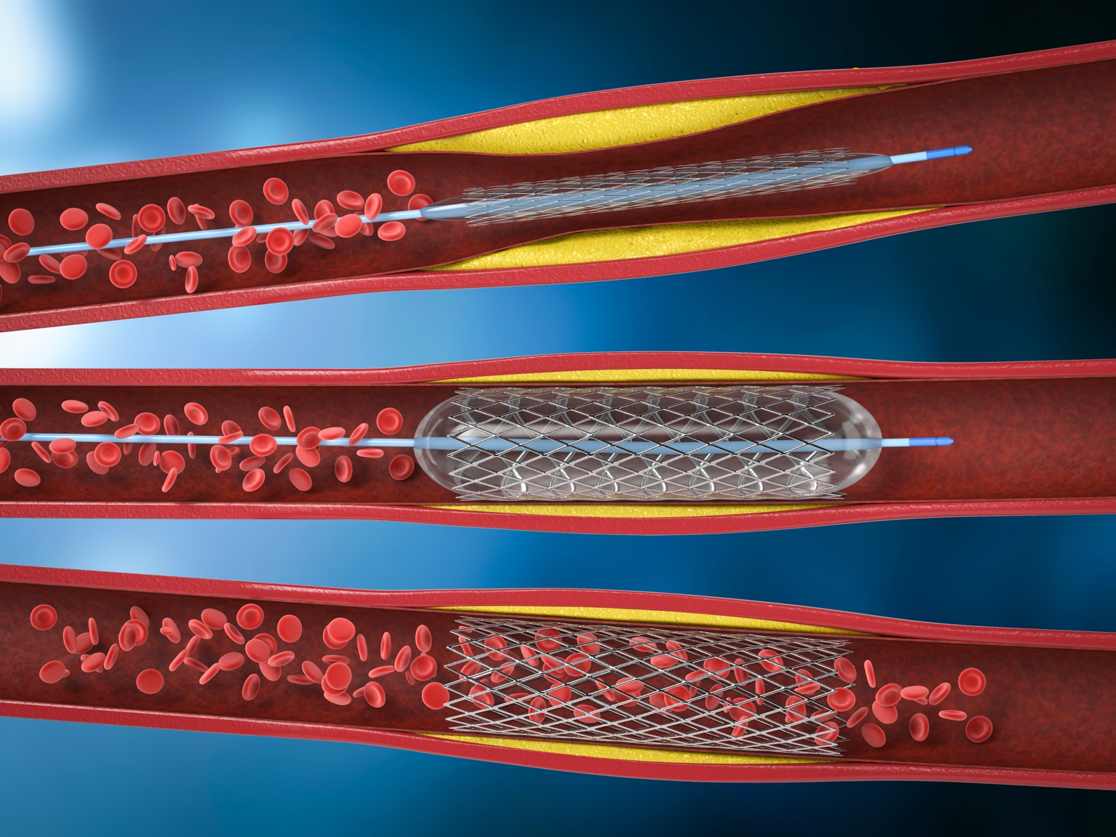 Coronary stent illustration